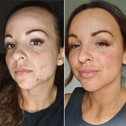 ProPlenish before and after