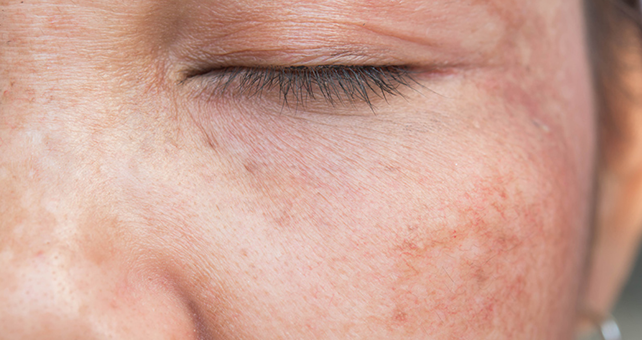 Hyperpigmentation on face